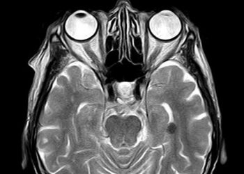 Studi: Kerusakan Otak COVID-19 Mirip Dengan yang Disebabkan oleh Stroke