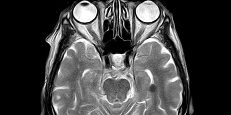 Studi: Kerusakan Otak COVID-19 Mirip Dengan yang Disebabkan oleh Stroke