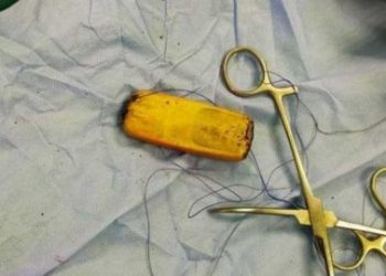 Dokter di Mesir Berhasil Keluarkan Ponsel dari Perut Seorang Pasien
