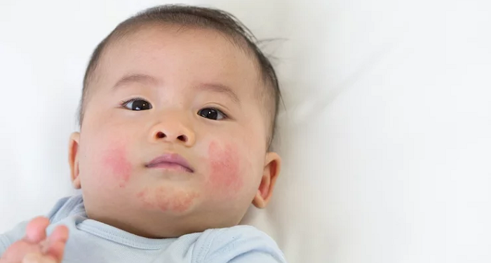 Mitos atau Fakta? Ruam Susu karena Percikan ASI