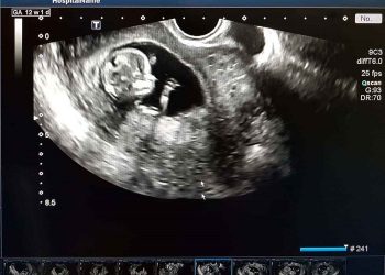 Cara Membaca Hasil USG Kehamilan yang Perlu Bunda Ketahui