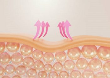 Berikut Beberapa Alasan Munculnya Jerawat dan Cara Mengatasinya