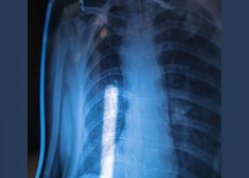 8 Cara Pengobatan Kanker Paru