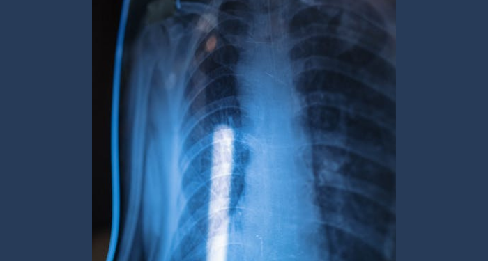 8 Cara Pengobatan Kanker Paru