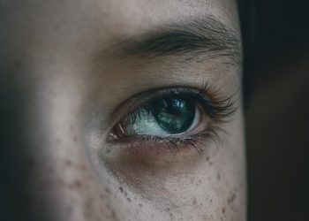 Ketahui Penyebab Melasma, Bintik Cokelat di Wajah