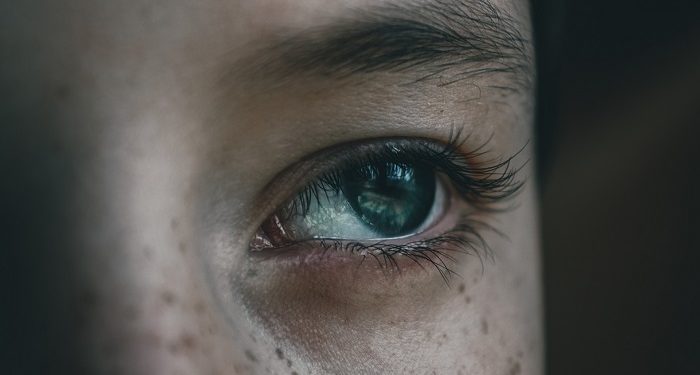 Ketahui Penyebab Melasma, Bintik Cokelat di Wajah