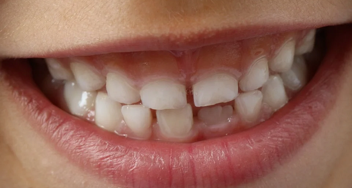 5 Kondisi yang Dianjurkan untuk Membersihkan Gigi