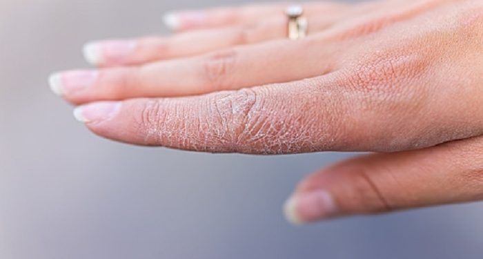 Kapan Kulit Kering Pada Masa Kehamilan Bisa Berbahaya?