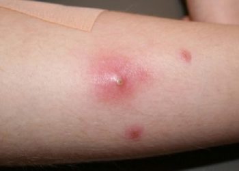 Cara Mengobati Bisul Pada Anak-Anak Menggunakan Bahan Alami