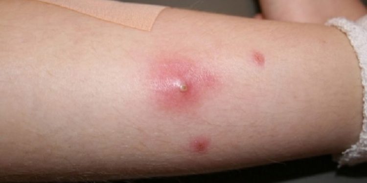 Cara Mengobati Bisul Pada Anak-Anak Menggunakan Bahan Alami