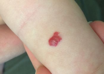 Hemangioma Stroberi, Tanda Merah Menggumpal Pada Newborn