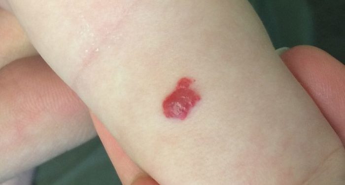 Hemangioma Stroberi, Tanda Merah Menggumpal Pada Newborn