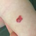 Hemangioma Stroberi, Tanda Merah Menggumpal Pada Newborn