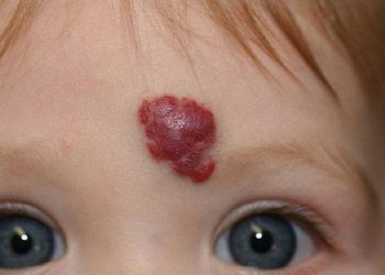 Penyebab Munculnya Hemangioma Stroberi Pada Newborn