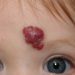 Penyebab Munculnya Hemangioma Stroberi Pada Newborn