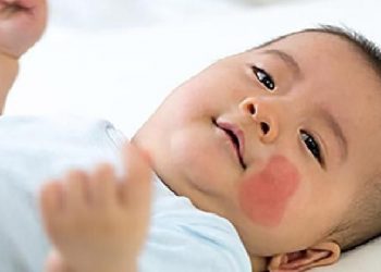 Cara Menghadapi Reaksi Orang lain Saat Melihat Tanda Lahir Si Kecil