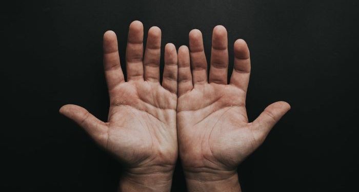 Kementerian Kesehatan Ungkap Cacar Monyet Bisa Sembuh Sendiri