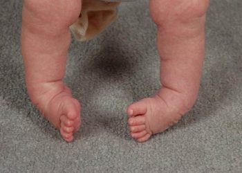 Mengenal Clubfoot, Kelainan Bentuk Kaki Pada Bayi