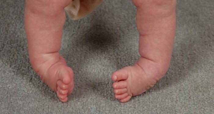 Mengenal Clubfoot, Kelainan Bentuk Kaki Pada Bayi