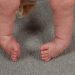 Mengenal Clubfoot, Kelainan Bentuk Kaki Pada Bayi