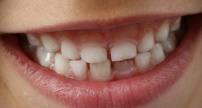 Merawat Kesehatan Gigi Balita Demi Asupan Nutrisi yang Baik