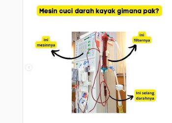 Divonis Cuci Darah, Apakah Sudah Pasti Seumur Hidup?