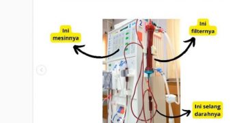 Divonis Cuci Darah, Apakah Sudah Pasti Seumur Hidup?