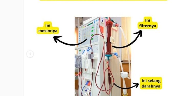 Divonis Cuci Darah, Apakah Sudah Pasti Seumur Hidup?