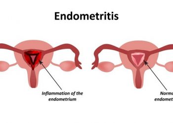 Endometritis atau Gangguan Kesuburan pada Wanita yang Harus Bunda Waspadai
