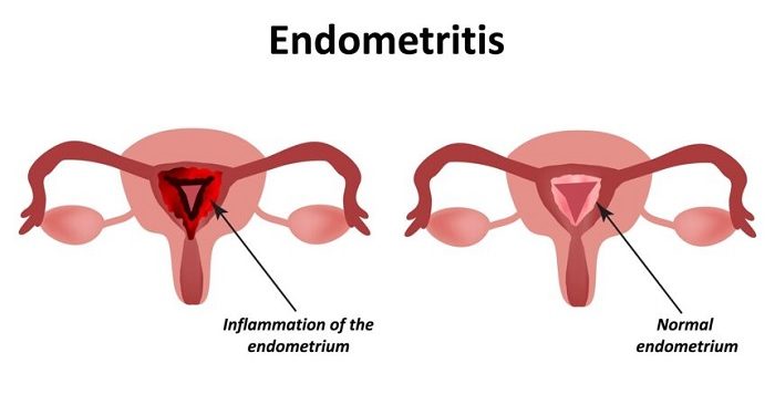 Endometritis atau Gangguan Kesuburan pada Wanita yang Harus Bunda Waspadai