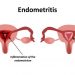 Endometritis atau Gangguan Kesuburan pada Wanita yang Harus Bunda Waspadai
