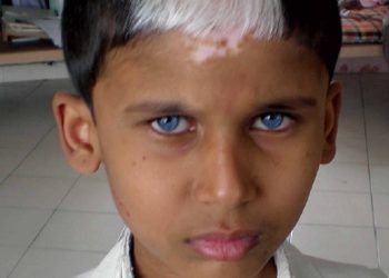 Sindrom Waardenburg, Kelainan Genetik pada Bayi Baru Lahir