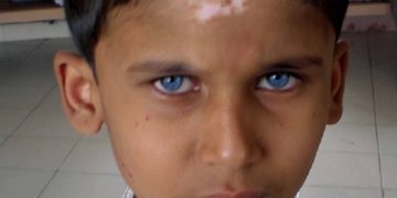 Sindrom Waardenburg, Kelainan Genetik pada Bayi Baru Lahir