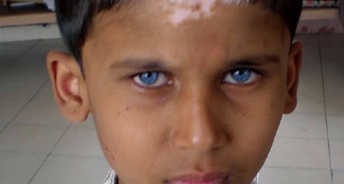 Sindrom Waardenburg, Kelainan Genetik pada Bayi Baru Lahir