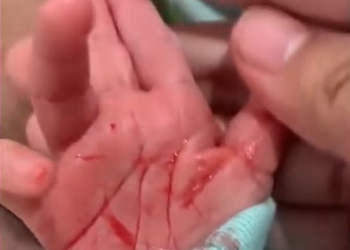 Terkena Penyakit Langka Hematohidrosis, Seorang Bayi Mengalami Keringat Berdarah