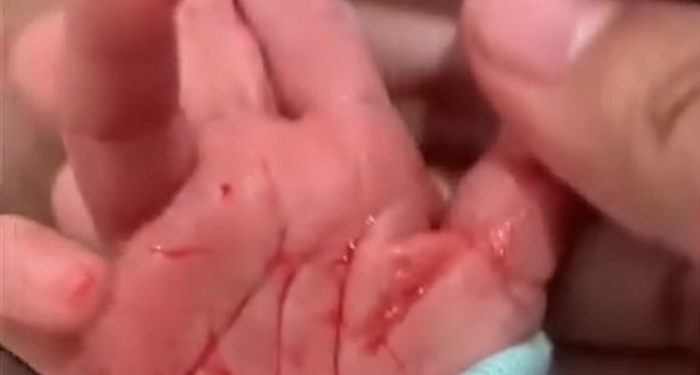 Terkena Penyakit Langka Hematohidrosis, Seorang Bayi Mengalami Keringat Berdarah