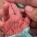 Terkena Penyakit Langka Hematohidrosis, Seorang Bayi Mengalami Keringat Berdarah