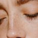 Lima Cara Ampuh Mengatasi Flek Hitam di Wajah Dengan Mudah