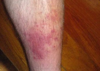 Bentol hingga Ruam Merah, Ketahui Cara Mencegah Biduran