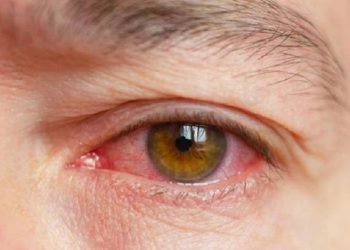 Simak, Tips Mengatasi Rasa Gatal Pada Mata