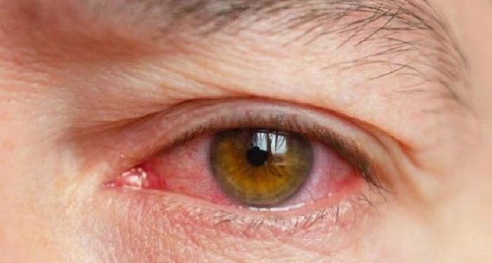 Simak, Tips Mengatasi Rasa Gatal Pada Mata