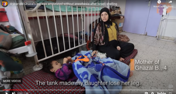 Generasi Muda Gaza Hadapi Krisis Amputasi di Tengah Perang