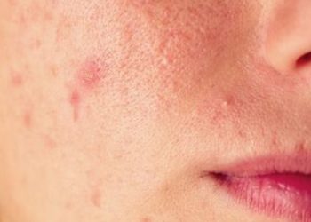 Kenali Tanda-Tanda Timbulnya Jerawat di Wajah