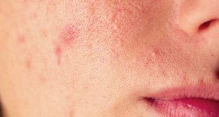 Kenali Tanda-Tanda Timbulnya Jerawat di Wajah