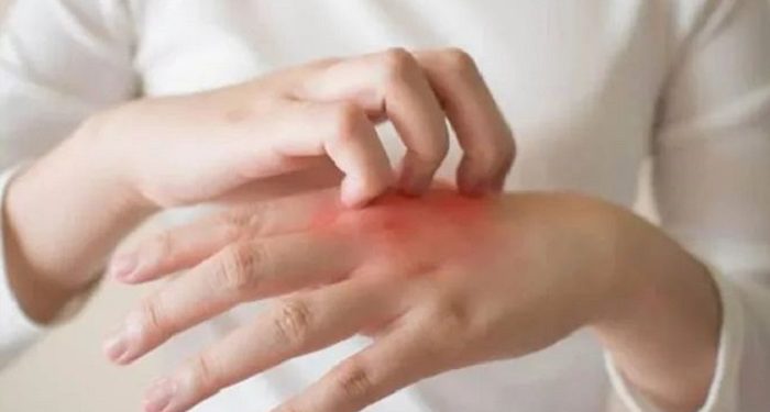 Cara Mengatasi Kulit Gatal di Malam Hari