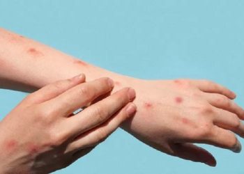 Kenali Penyakit Mpox dan Gejalanya