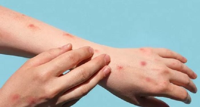 Kenali Penyakit Mpox dan Gejalanya