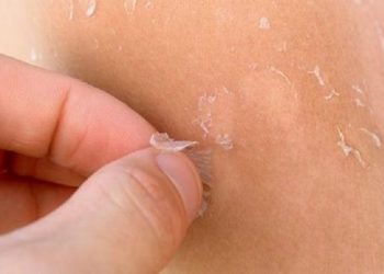 Simak Tujuh Bahaya Kulit Kering