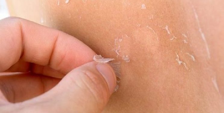 Simak Tujuh Bahaya Kulit Kering