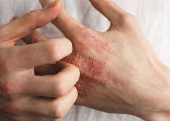 Kenali Jenis-Jenis dan Gejala Dermatitis